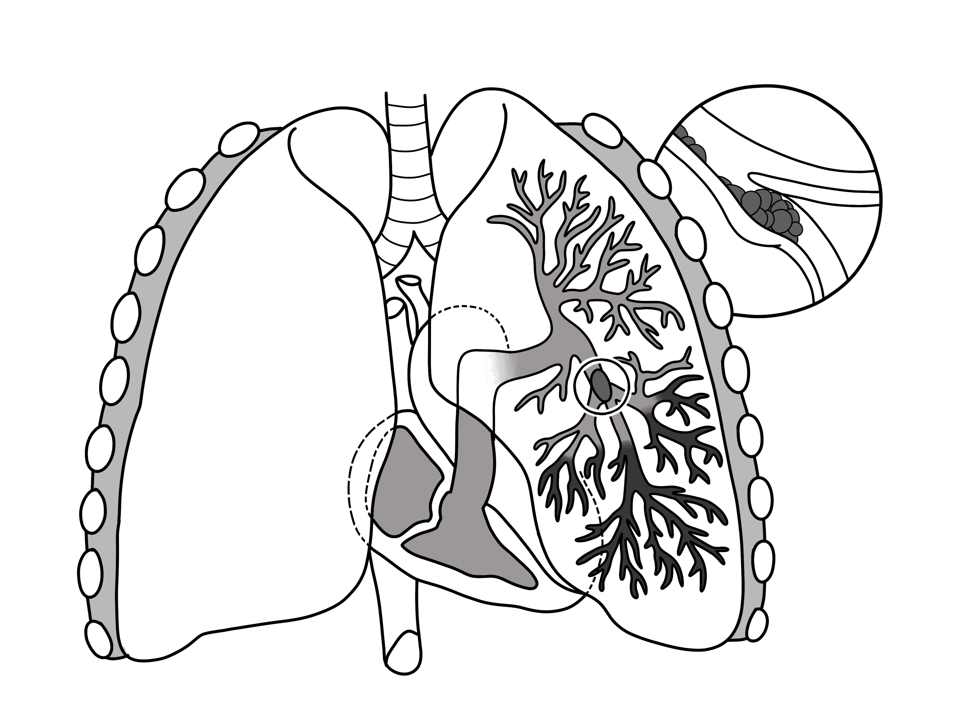 Pulmonary embolism - Wikipedia